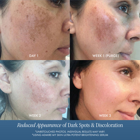 Ultra Potent Brightening Serum For Dark Spots & Uneven Skin Tone