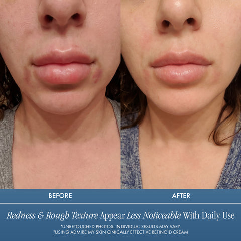 Clinically Effective Retinoid Cream - Over The Counter Retinol