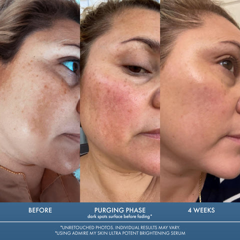 Ultra Potent Brightening Serum For Dark Spots & Uneven Skin Tone