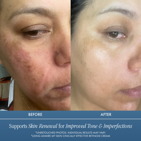 Clinically Effective Retinoid Cream - Over The Counter Retinol