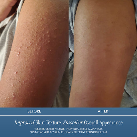 Clinically Effective Retinoid Cream - Over The Counter Retinol